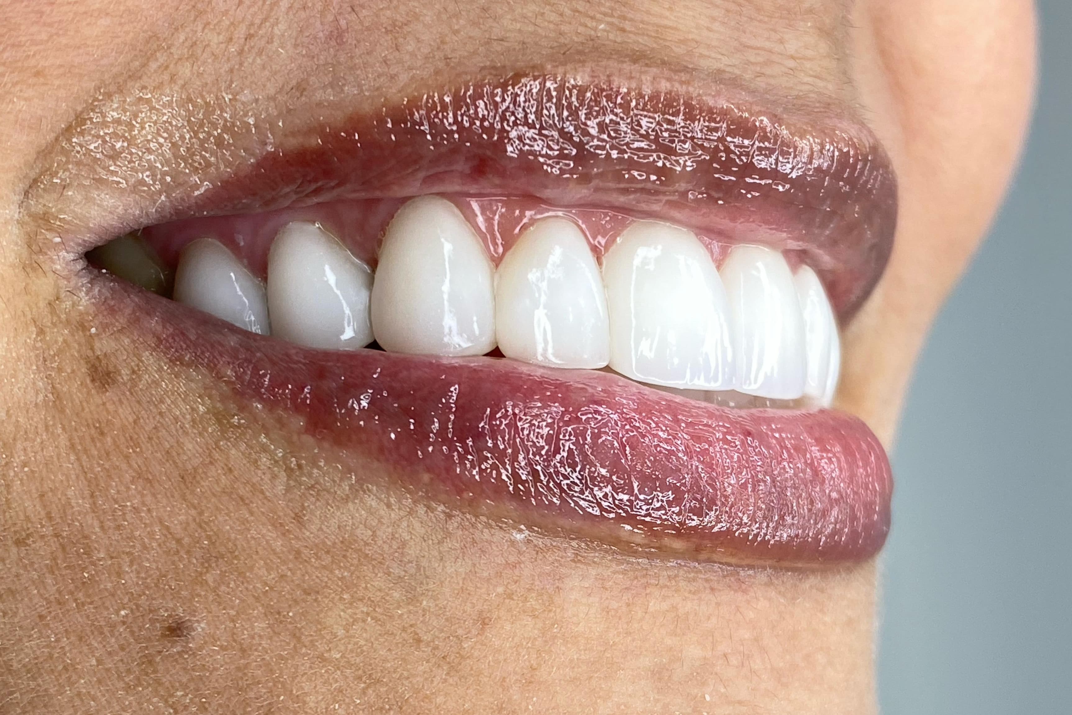 Estética Dental